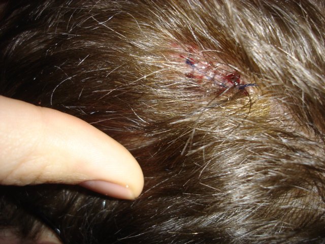 The stitches, closing the hole that got cut into my head today.